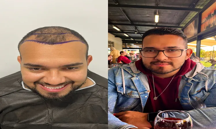 Türkiye Saç ekimi (TurkeyHair Transplant)