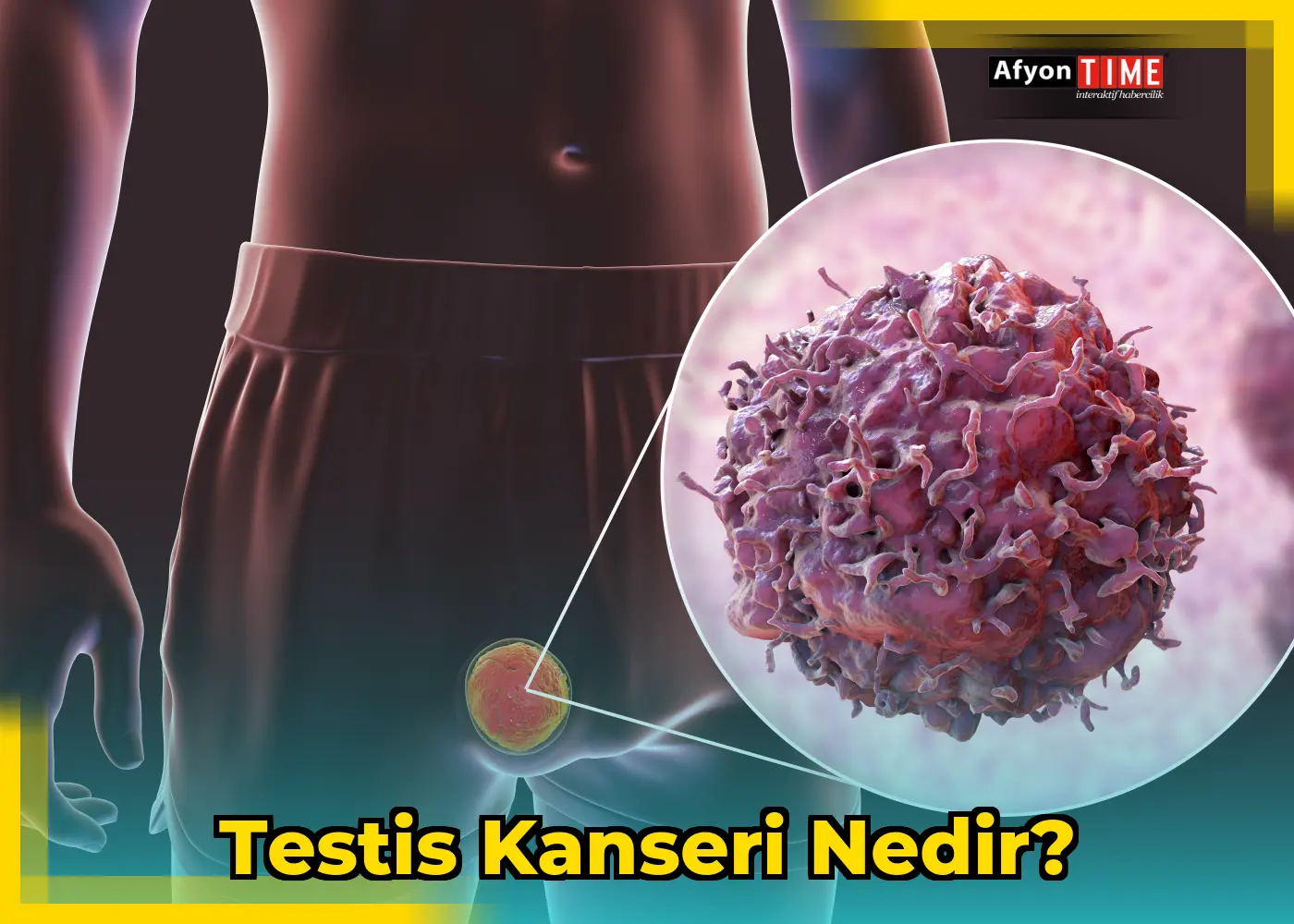 Testis Kanseri Nedir?